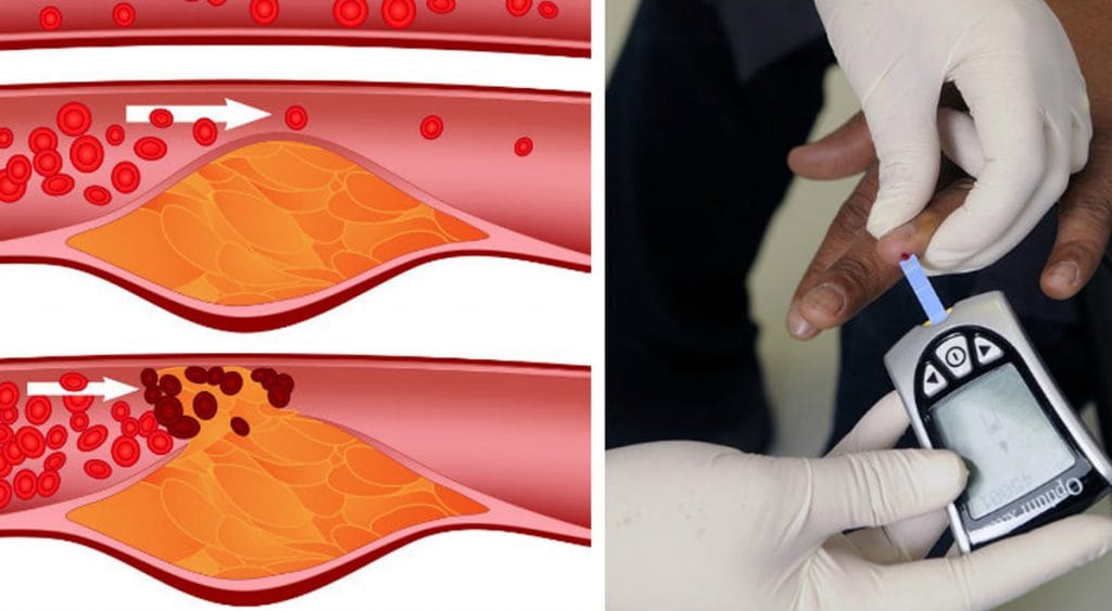 Colesterolo alto? 7 cose che dovresti fare per abbassarlo in 30 giorni