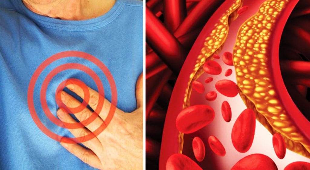 Colesterolo cattivo, 5 cose che dovresti fare per pulire le arterie dal grasso