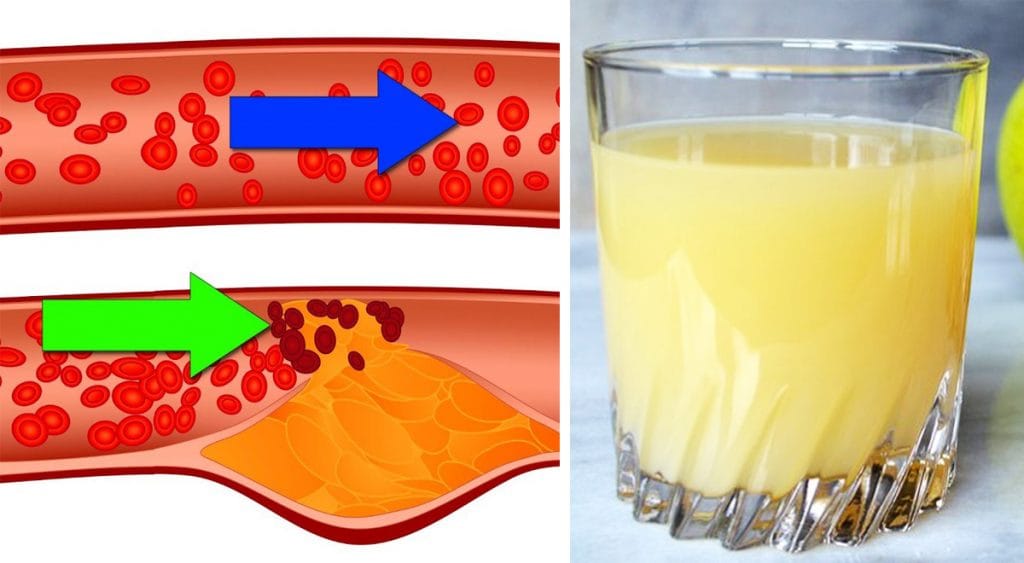 Mela, zenzero e stevia: abbassa il colesterolo, migliora la glicemia e pulisce da tossine