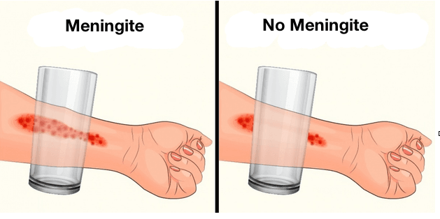 Meningite, tumbler test (del bicchiere)