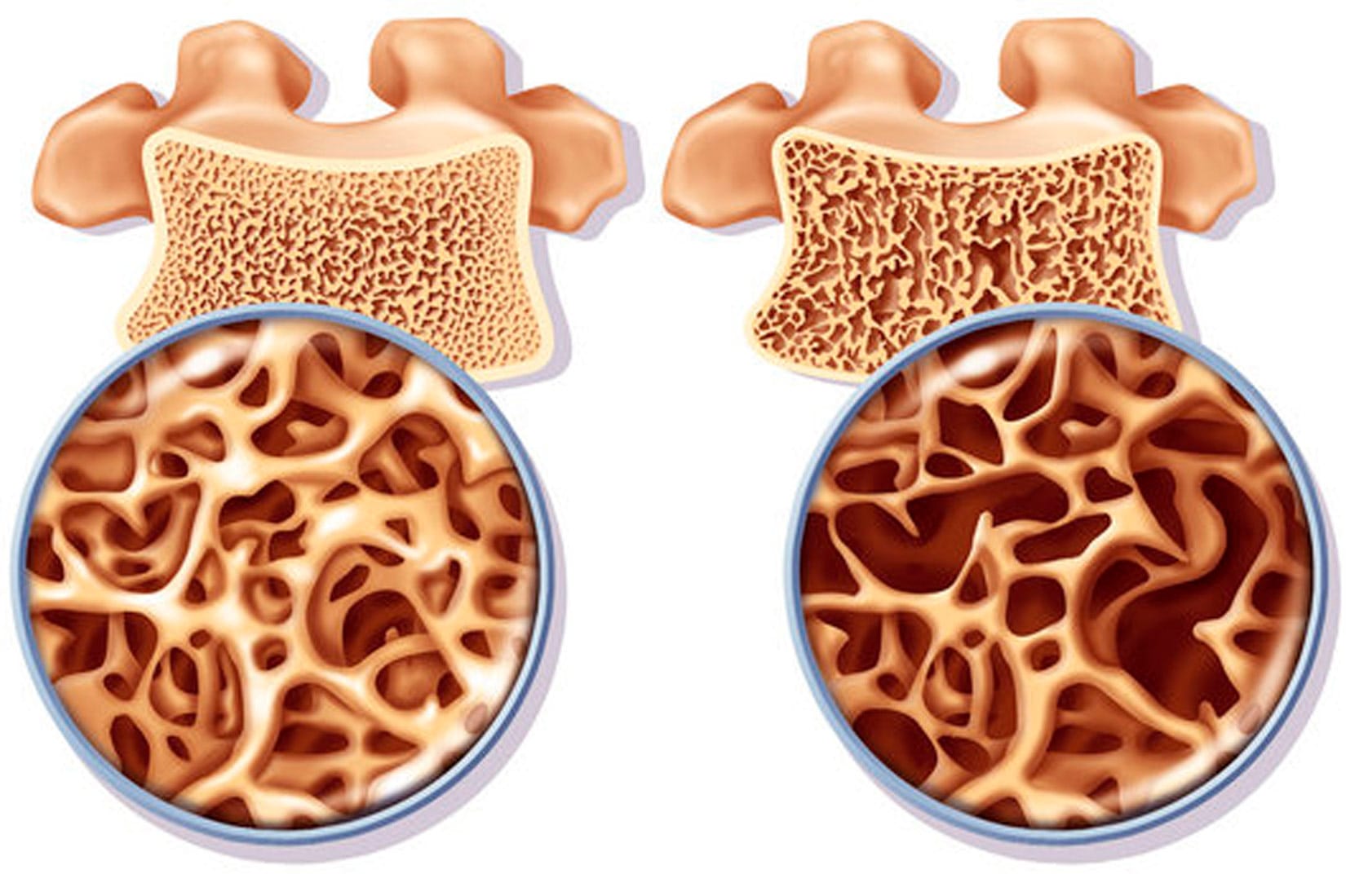 Osteoporosi