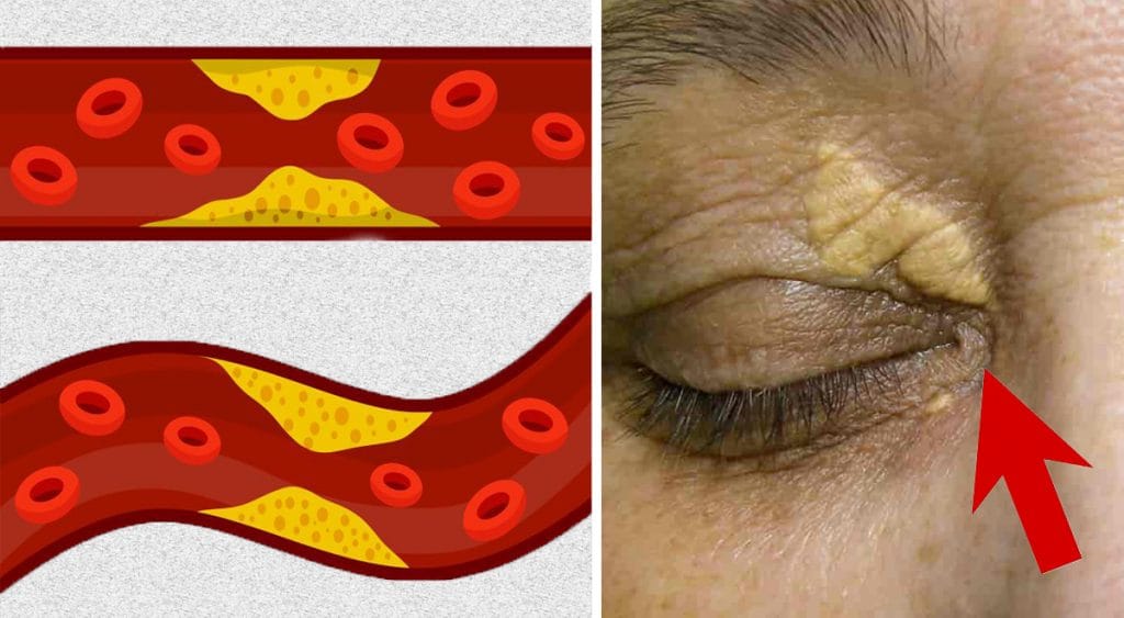 Colesterolo e trigliceridi alti? Ecco i valori a rischio che non bisogna mai superare!