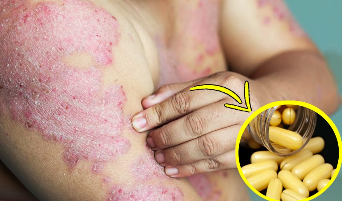 Carenza di vitamina D, può causare malattie della pelle