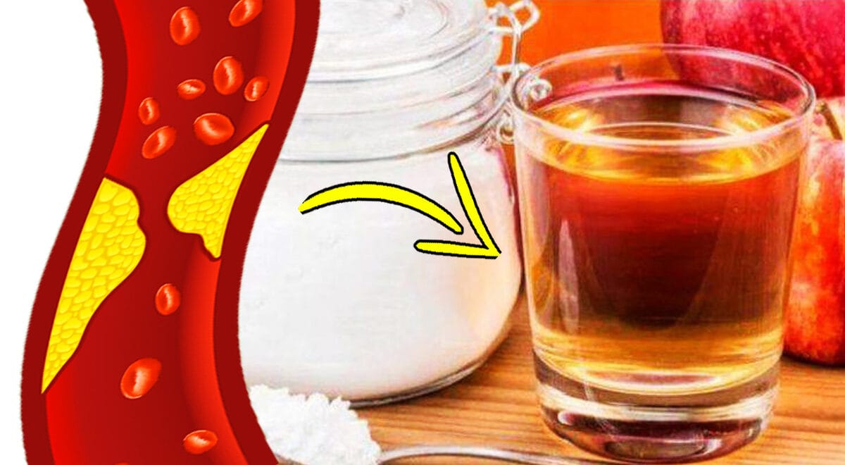 Aceto di mele e bicarbonato, abbassa il colesterolo e contrasta l'acidità di stomaco
