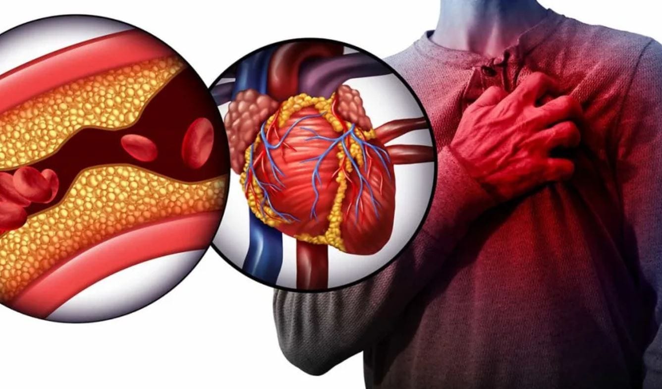 Infarto, i 3 segnali da non sottovalutare mai!